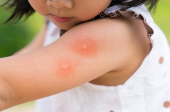 Meu filho tem alergia a picada de inseto, e agora?