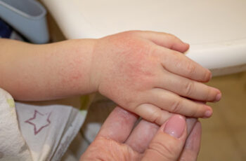 Dermatite atópica infantil: maioria supera a doença na vida adulta