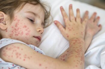 Mpox em crianças: sintomas, risco e prevenção